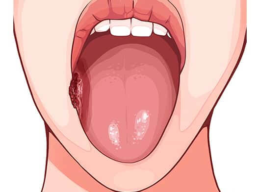 oral-cancer